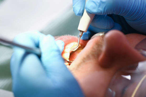 Best Emergency Dentist for Knocked-Out Tooth in Weaverville, CA